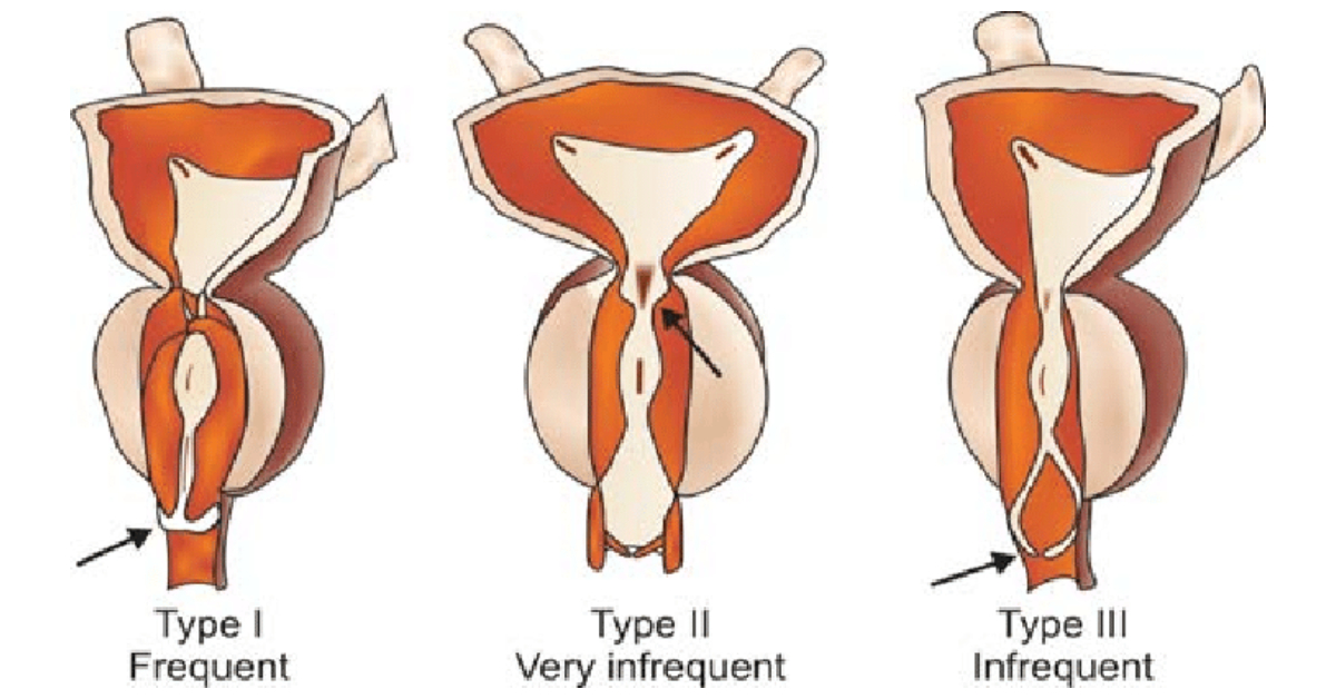Posterior Urethral Valves